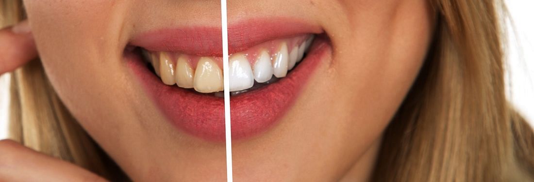 Skuteczne metody wybielania zębów 