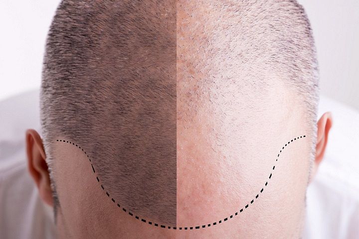 Przełom w leczeniu łysienia u mężczyzn 