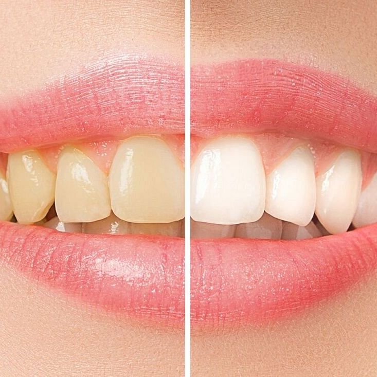 Z jasnymi zębami Ci do twarzy – o metodach rozjaśniania i wybielana